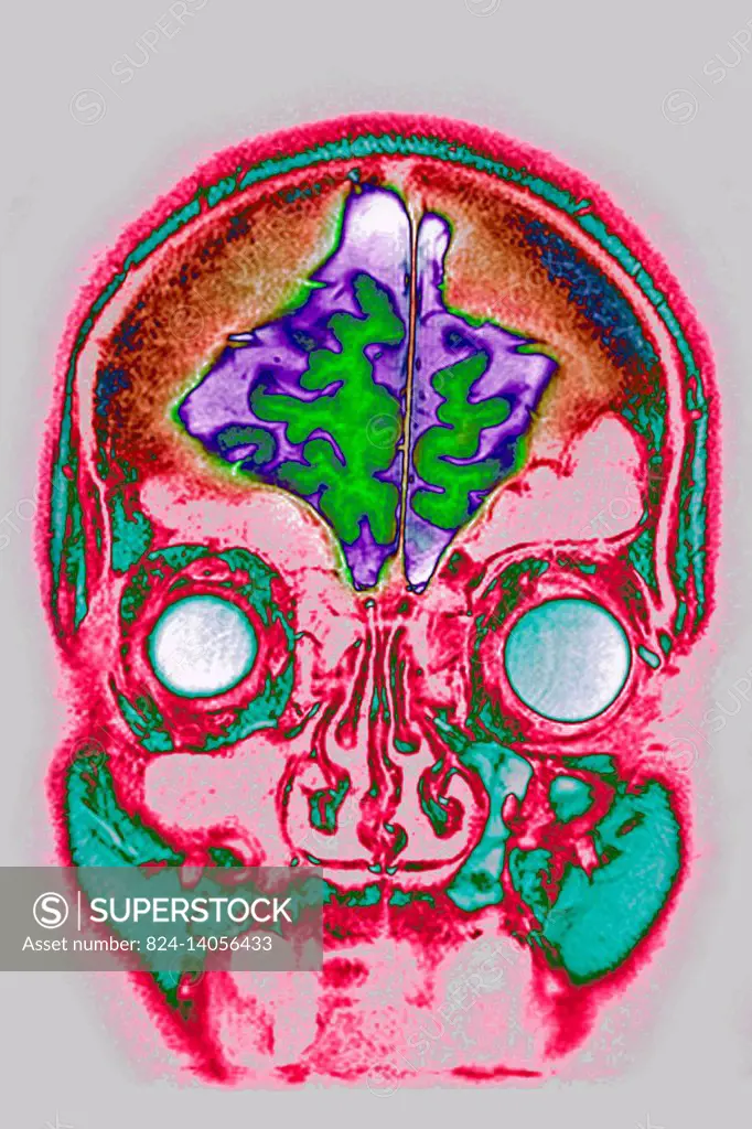 Cerebral atrophy (anterior temporal and parietal frontal pontocerebellar) frontal cross-section MRI cranial scan.