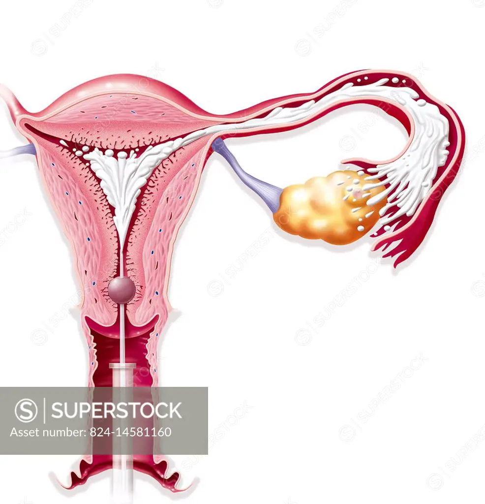 Illustration of hysterosalpingography: a radiologic procedure of the uterine cavity and fallopian tubes which enables malformations and tumours in the...