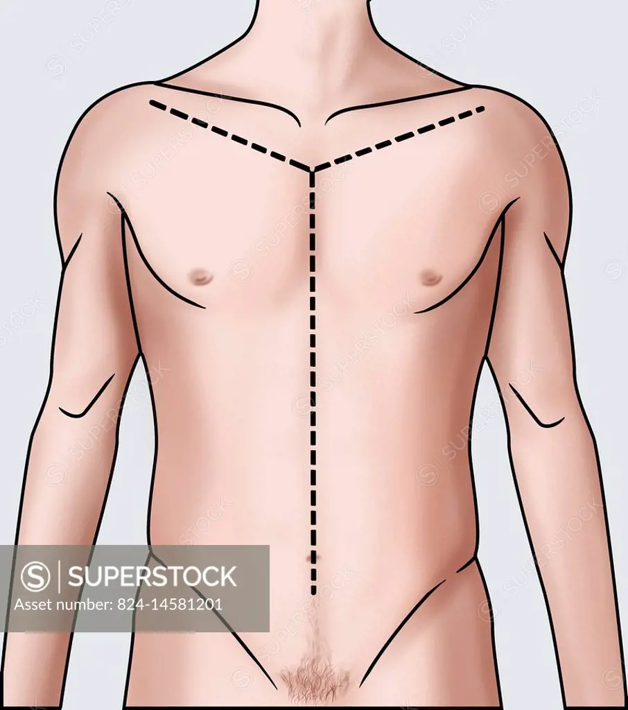 Illustration showing the Y-shaped incision made during an autopsy