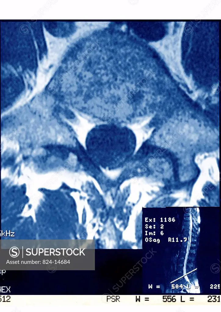 This axial MRI image of the lumbar spine reveals a spondylodiscitis at the L5 level.