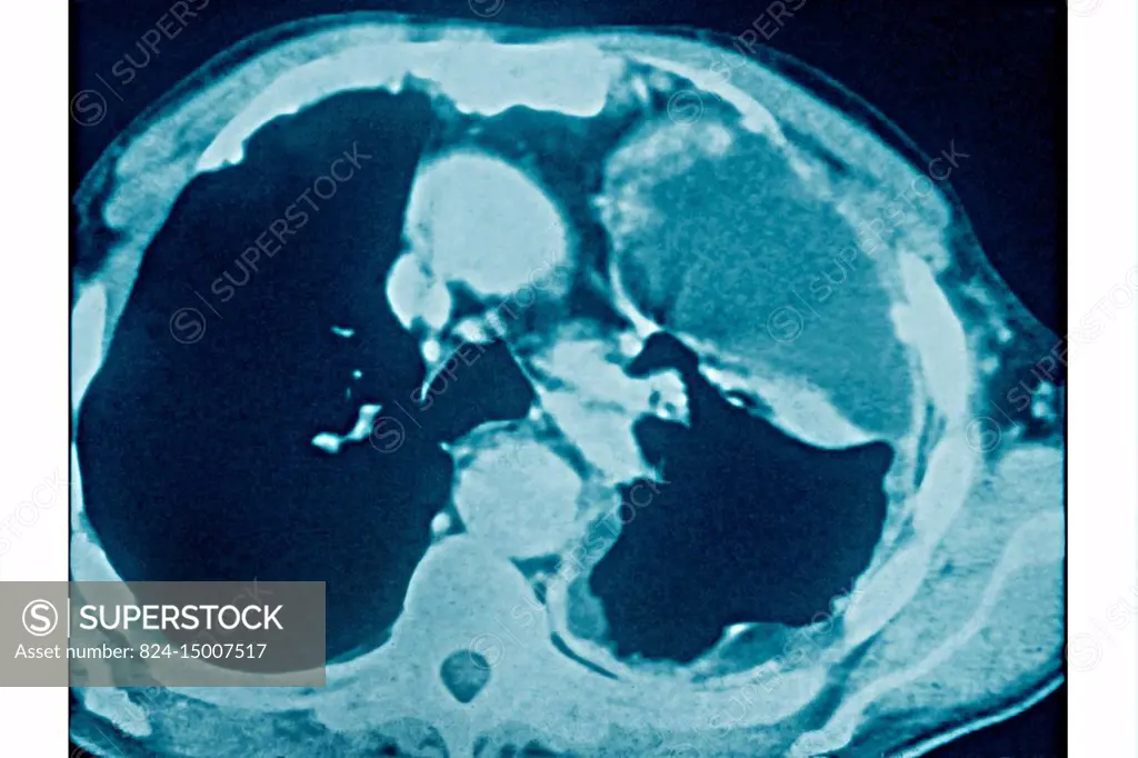 Lung cancer caused by asbestosis, seen on a radial section CT chest scan.