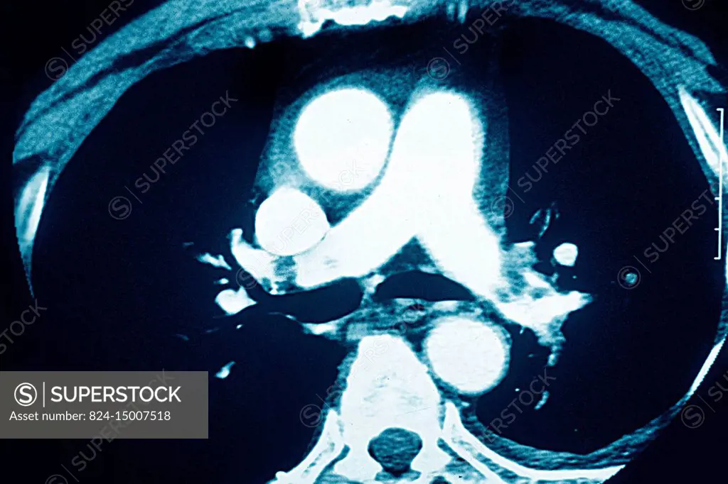 Pulmonary embolism in the left and right pulmonary arteries, seen on a radial section chest CT scan.