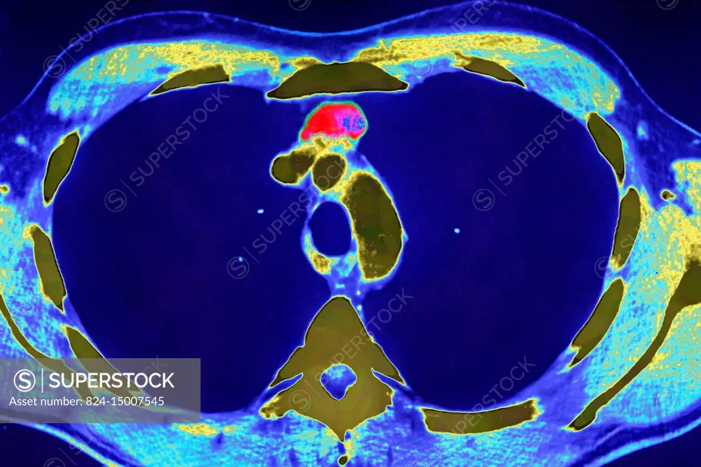 Thymus cancer seen on a cross-section chest CT scan.