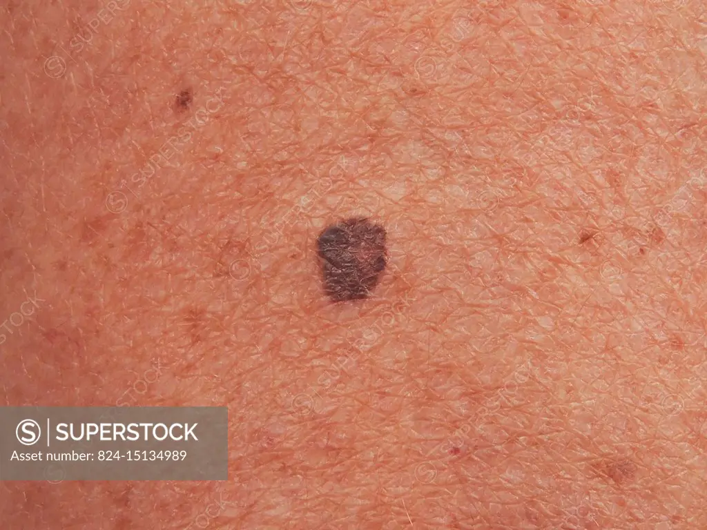 Intraepidermal malignant superficial spreading melanoma (SSM) on the thigh.