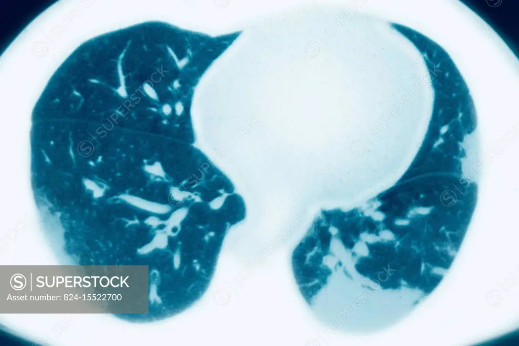 Pulmonary infarction (pulmonary embolism) seen on a radial cross-section chest CT scan.