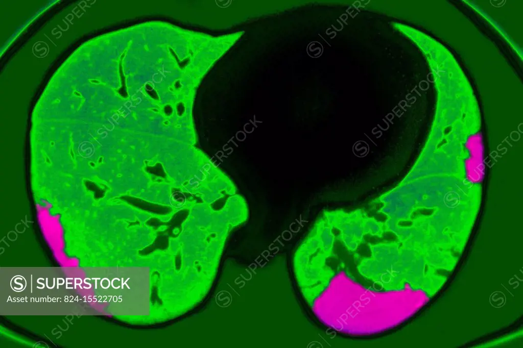 Pulmonary infarction (pulmonary embolism) seen on a radial cross-section chest CT scan.