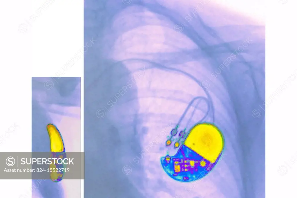 Pacemaker implanted in the chest. Frontal and side chest x-ray.