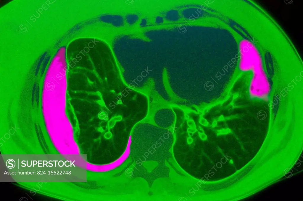 Pleurisy seen on a radial cross-section chest MRI scan.