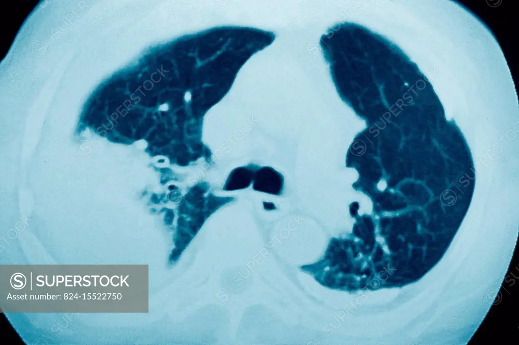 Pleurisy seen on a radial cross-section chest CT scan.