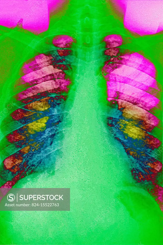 Pulmonary sarcoidosis seen on a frontal chest x-ray.