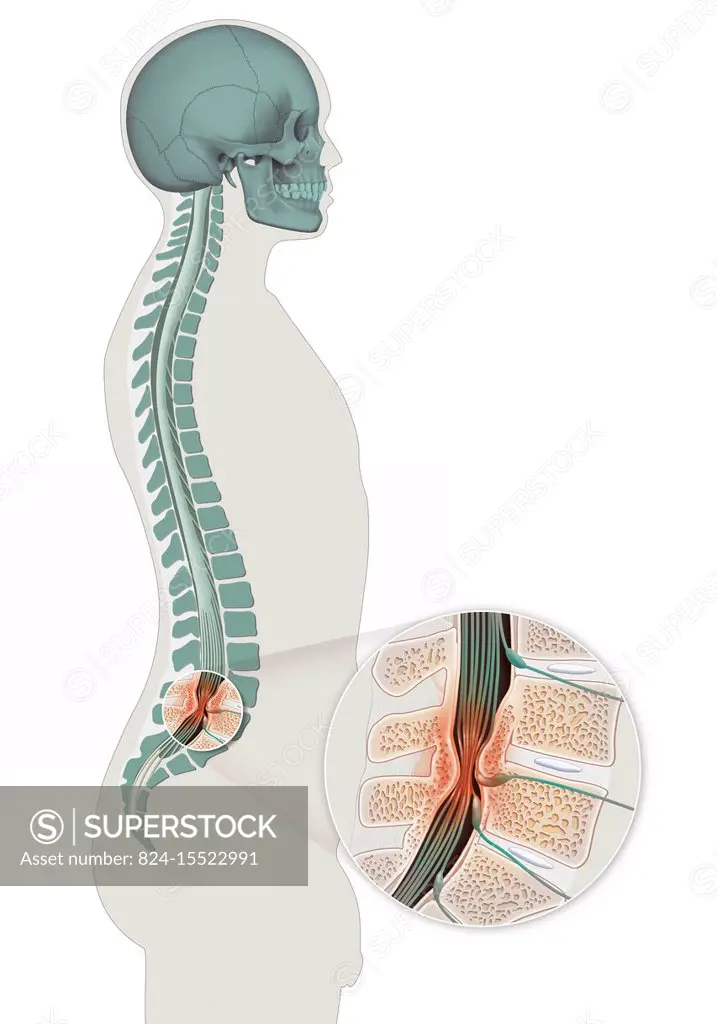 Illustration of spinal stenosis in L4 and L5. Spinal stenosis is a pathology located in the lumbar spinal column where the cauda equina nerves pass. I...