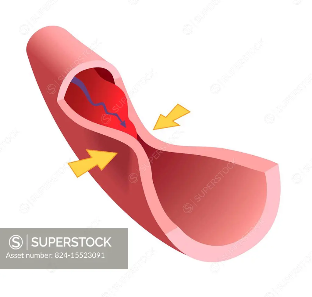 Coronary spasm is a spasm that affects the hearts blood vessels, and the coronary arteries in particular. This spasm reduces artery size, resulting i...