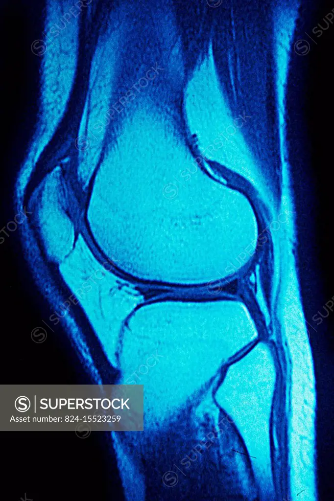 Normal knee seen on a sagittal section MRI scan.