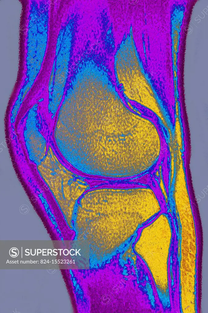 Normal knee seen on a sagittal section MRI scan.