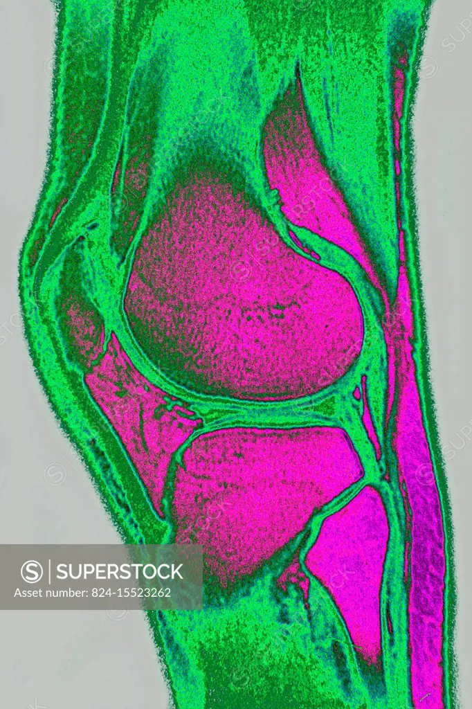 Normal knee seen on a sagittal section MRI scan.