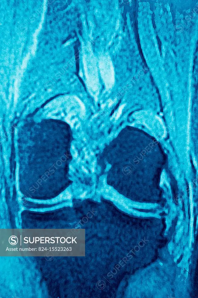 Normal knee seen on a frontal MRI scan.