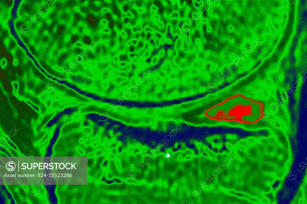 Lesion of the meniscus posterior horn. Sagittal section MRI scan of the knee.