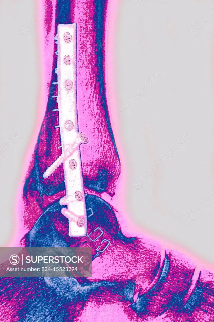 Screw and plate osteosynthesis on a fracture of the fibula. Profile x-ray: tibia, fibula, malleolus and astragalus.