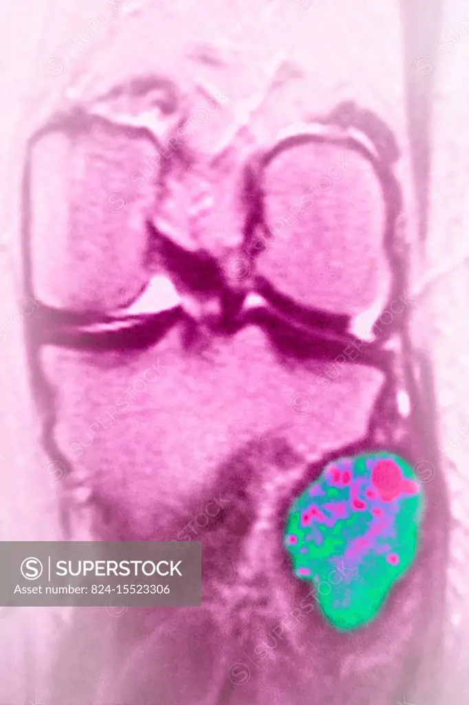 Osteosarcoma of the fibula. Knee seen on a frontal MRI scan.