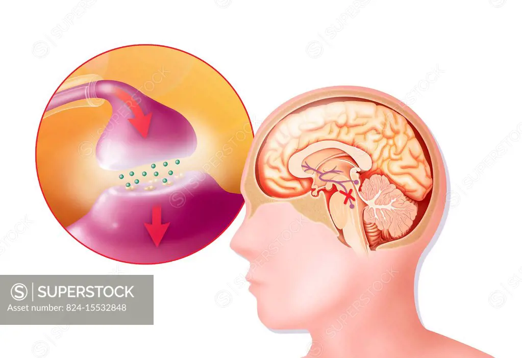 Illustration of Parkinsons disease. It affects dopamine neurons in the substantia nigra. Dopamine, vital for transmitting the nerve impulse used in c...