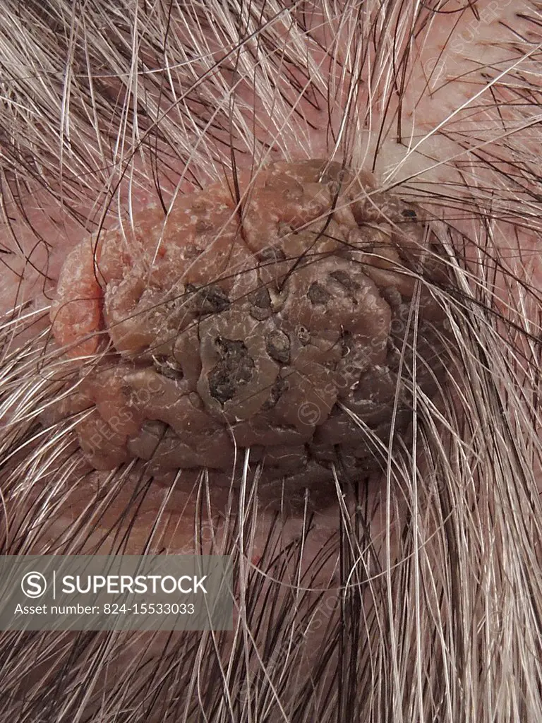 Seborrheic keratosis of the scalp.