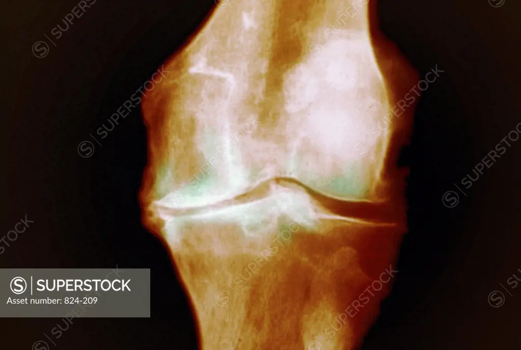 Knee X-Ray Showing Osteoporosis