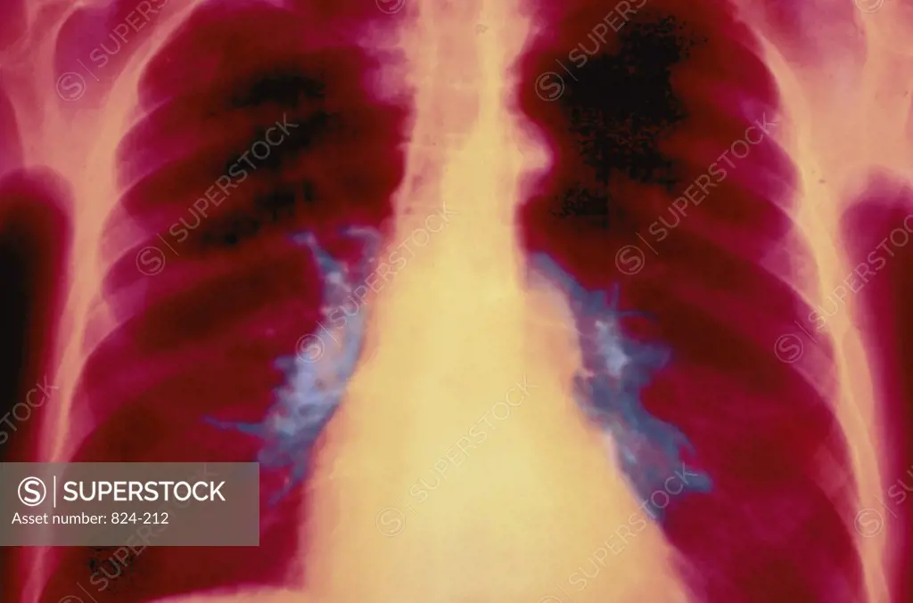 X-Ray of Abnormal Lungs