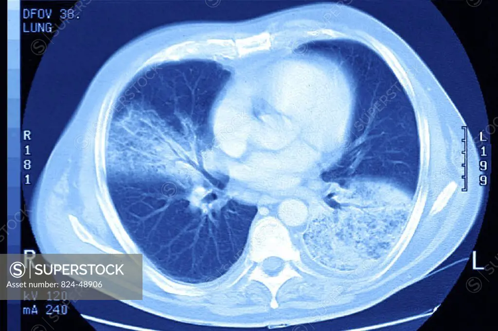 PNEUMOCOCCAL PNEUMONIA, SCAN<BR>Pneumonia. Pneumonopathy due to Streptococcus pneumoniae. Thoracic CT scan.