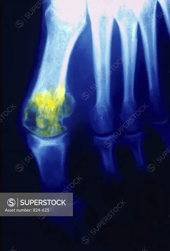 X-Ray Showing Gout In Big Toe