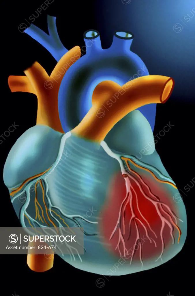 Human Heart with Infarction