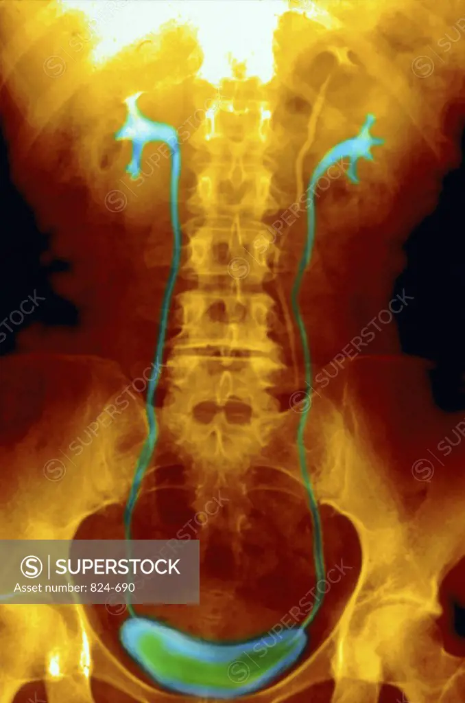 X-Ray Showing Urinary System