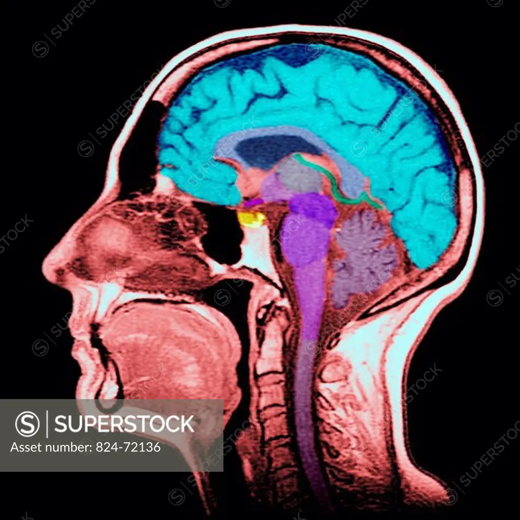 HEAD, MRI<BR>Sagittal section.  (Cf. image 0212106 for the numbers)  1. Brain.  2. Corpus callosum (splenium).  3. Septum lucidum.  4. Thalamus.  5. M...