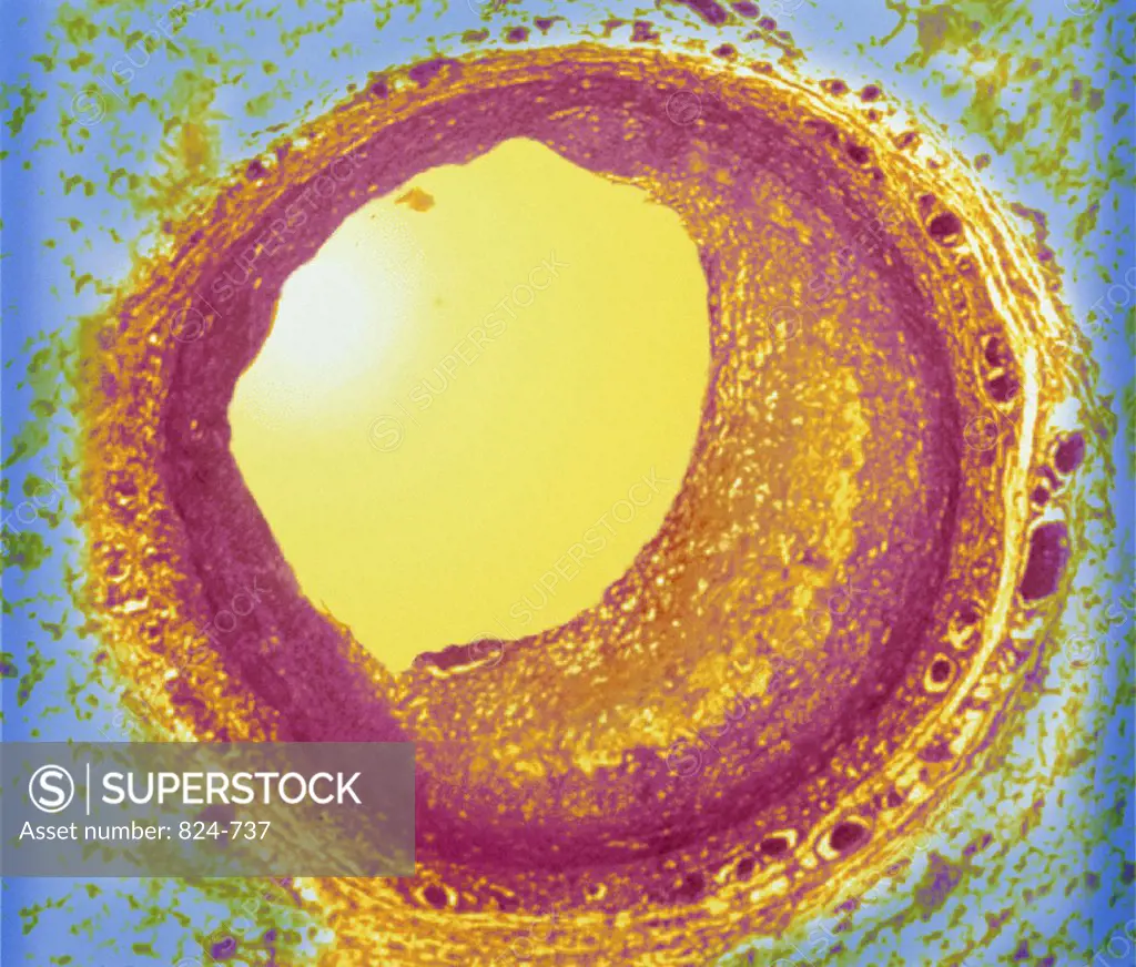 Human Artery showing Atheroma