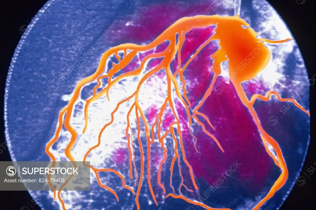 CORONARY ANGIOGRAPHY<BR>The coronary arteries originate from the aorta and supply blood to the heart muscle. An angiogram (arteriogram, cardiac cathet...