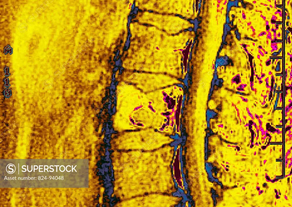 This sagital MRI image of the lumbar spine shows a multiple myeloma, marked by bone destruction osteolysis.